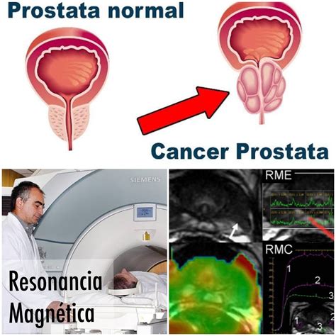 cancer de prostata-4